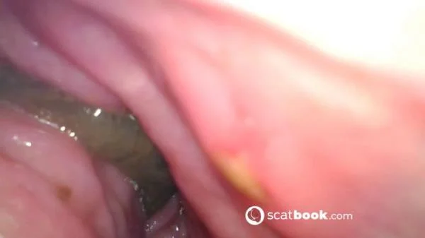 Endoscope In My Ass (Sweet Tinqerbell) 19 April 2025 [FullHD 1080p] 647 MB