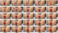 Dirtiest Anus Prolapse Part 1 (Rosemia) 26 January 2026 [HD 720p] 4.51 MB